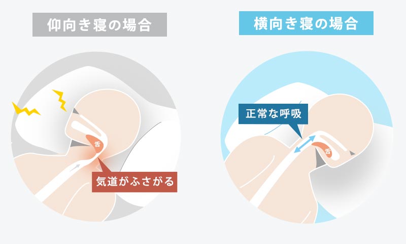 仰向き寝の場合は、気道がふさがりやすいが、横向き寝の場合は、舌が落ち込むのを防ぐため正常な呼吸がしやすい。
